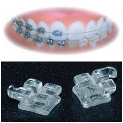 Tooth Coloured Braces parts